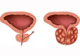 Plasturi urologice pentru analize de prostatită